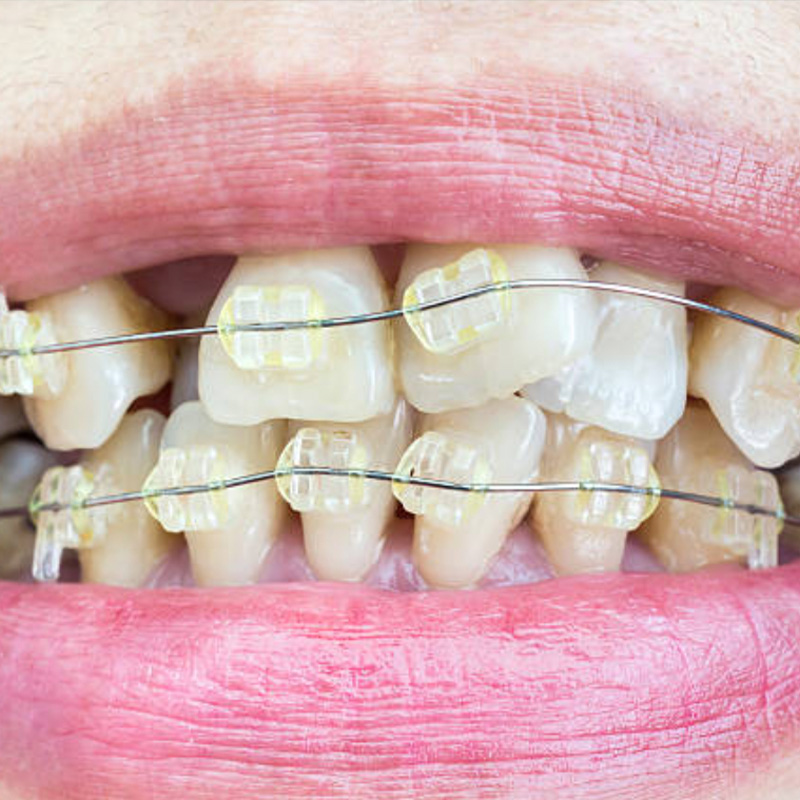 Application of braces in Adelaide