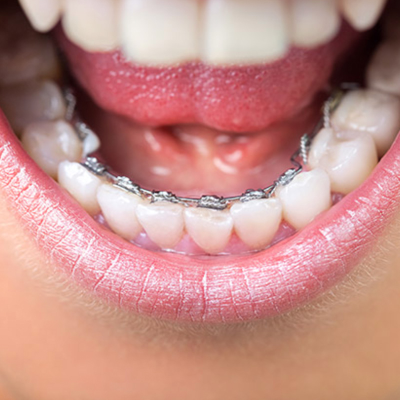 Dental braces checkups Adelaide