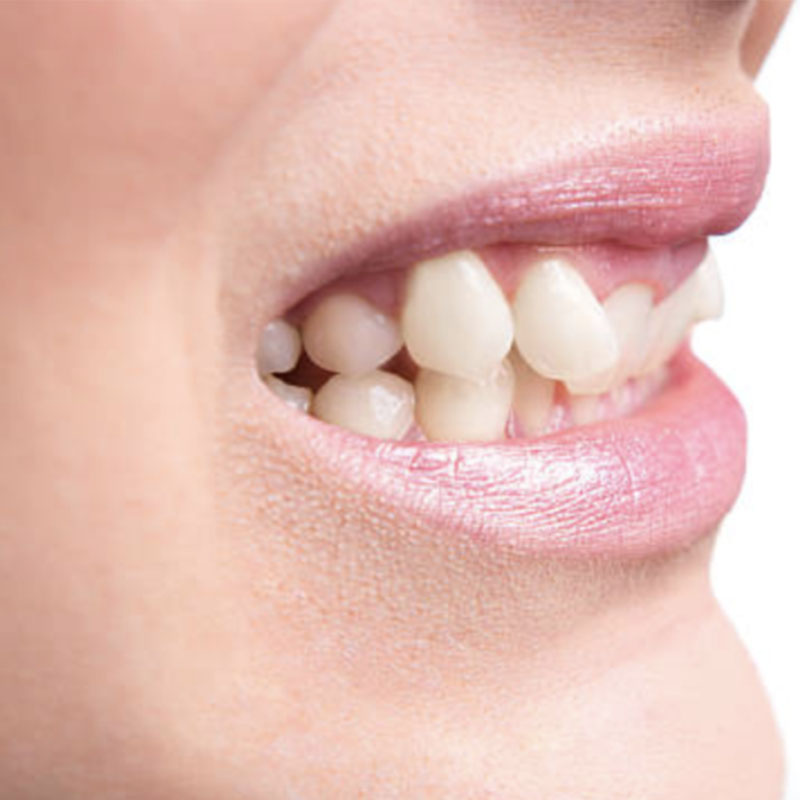 How To Fix Crooked Teeth With Invisalign