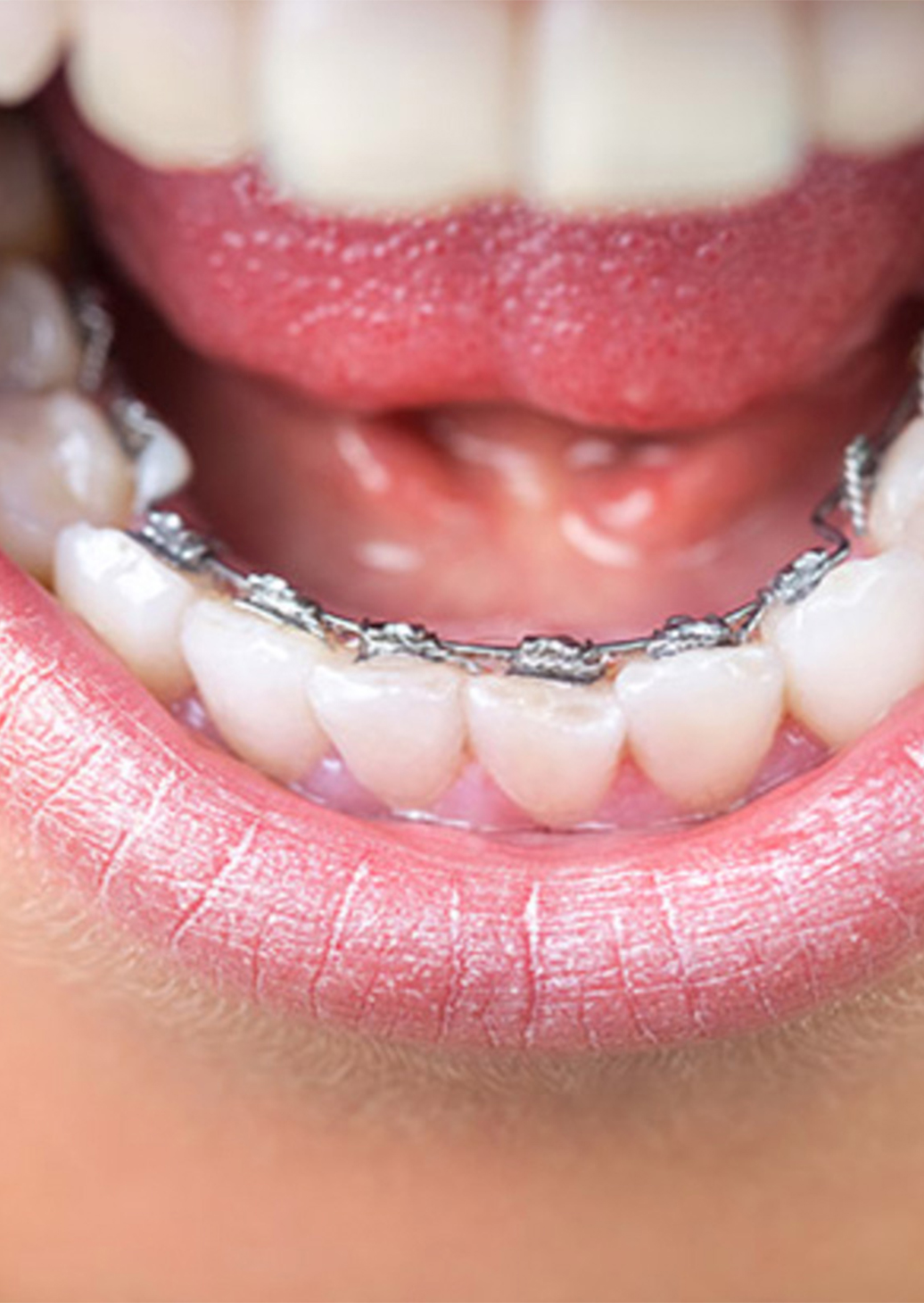 Incognito Braces Adelaide | Adelaide Orthodontists - Speciality Orthodontists in Adelaide, South Australia